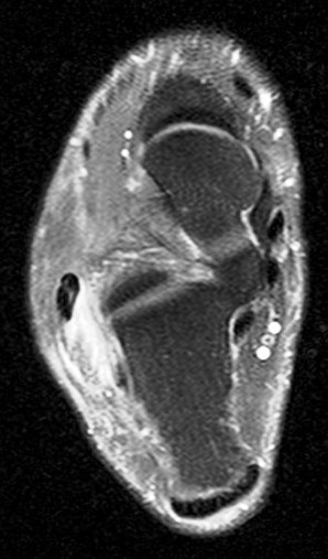 Figure 3 for case peroneal dislocation